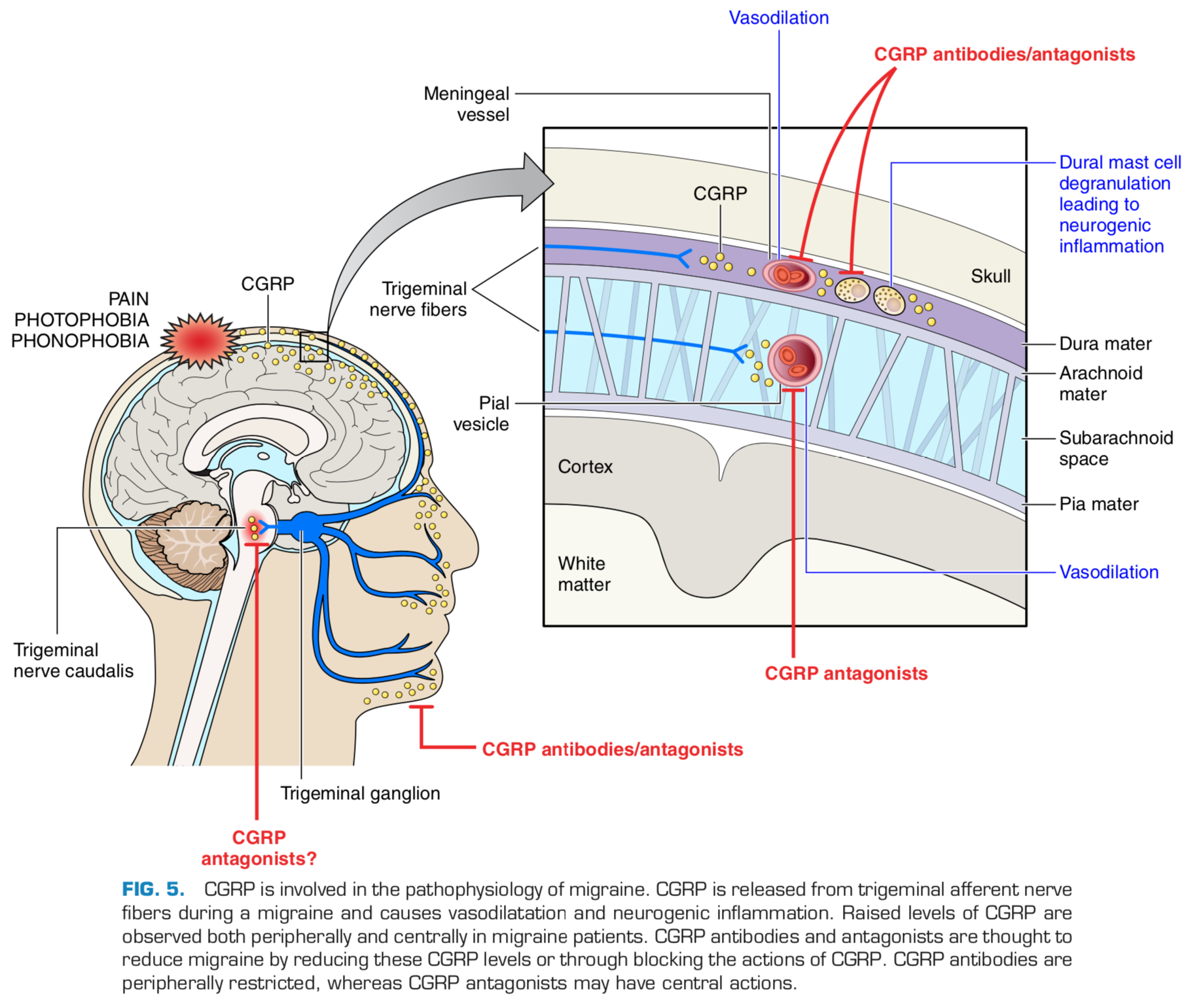 Звонкий сосуд. Патогенез мигрени схема. Механизм развития боли при мигрени. Патогенез мигрени CGRP. Патогенез мигрени неврология.