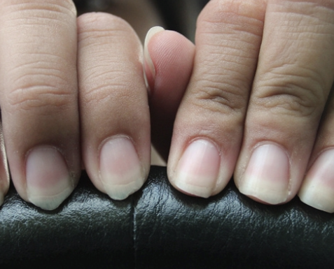 Do Discolored Nails Mean Something? | American Council on Science and Health