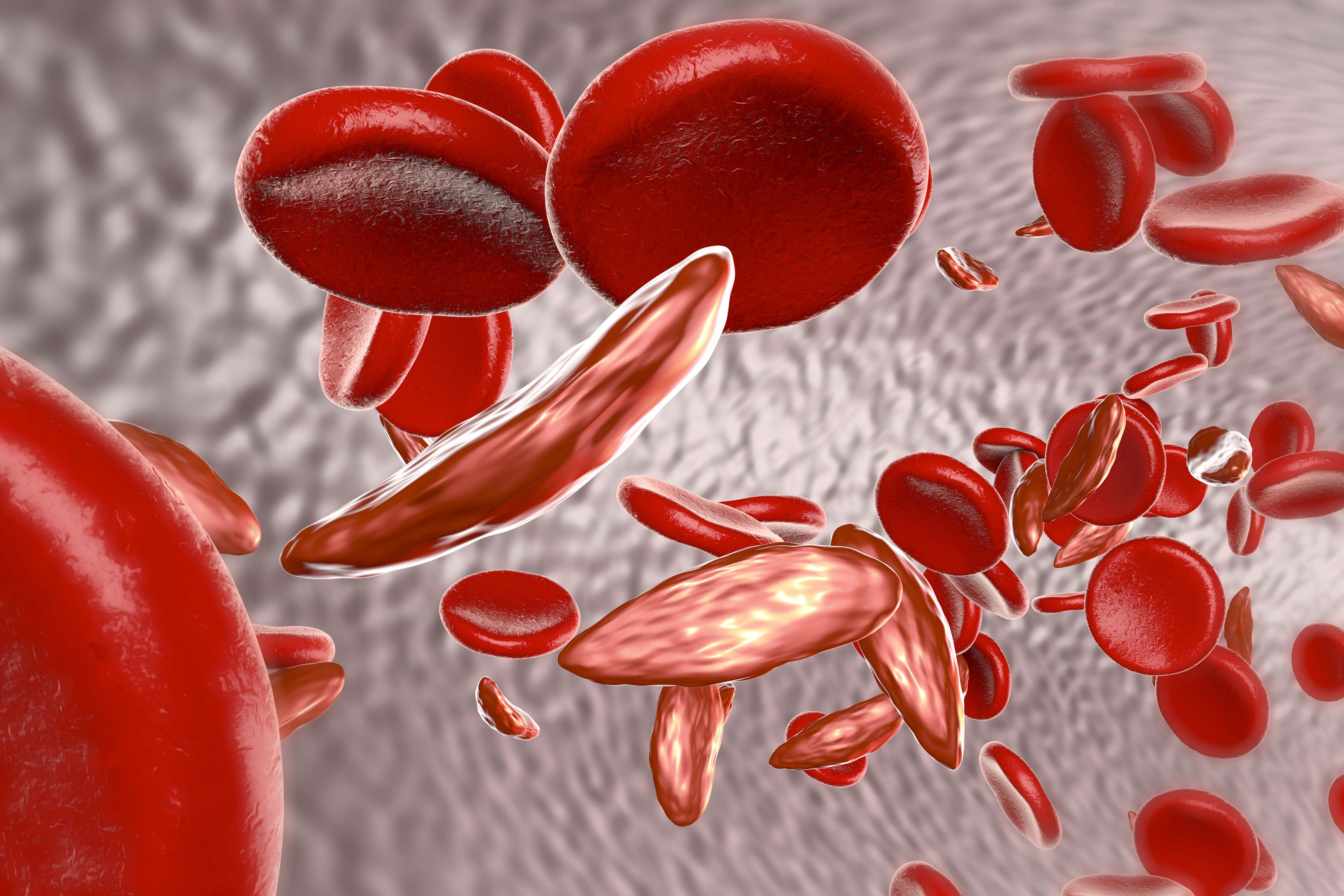 Did Gene Therapy Cure Sickle Cell Disease? | American Council on